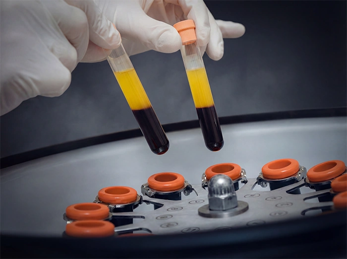Advanced Platelet Therapy